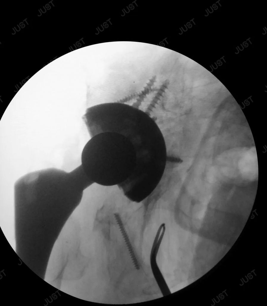 How to Choose Implants and Instruments for Acetabular Revision?
