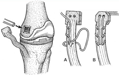 Valgus Knee-Medial Ligament Advancement