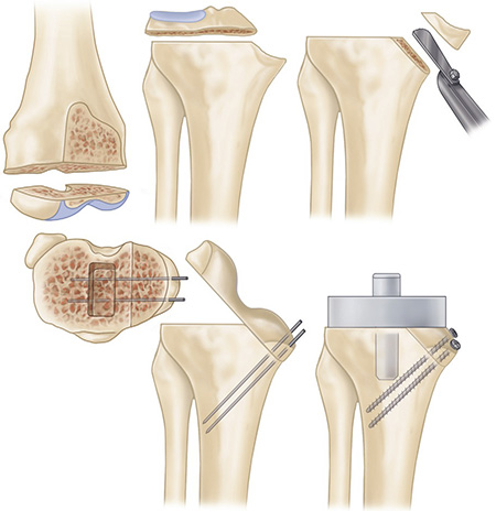 Valgus Knee (VII) Management Of Bone Defect