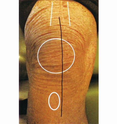 Primary Total Knee Arthroplasty Surgical Technique