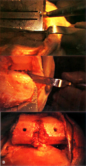 Four-in-one osteotomy