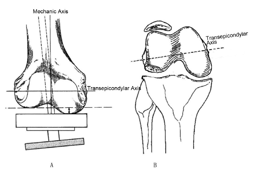 Valgus Knee(Ⅳ)Bone Preparation