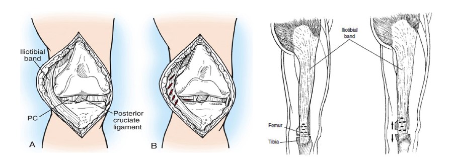 Valgus Knee(Ⅴ)Soft Tissue Balance