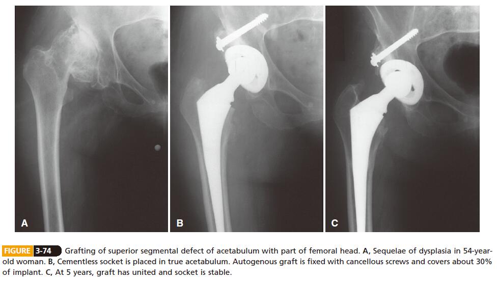 Surgery of DDH of acetabulum