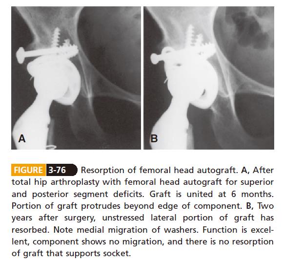 Surgery of DDH of acetabulum Ⅱ