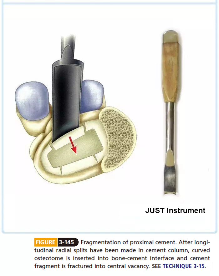 Removal of femoral cement
