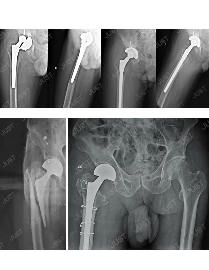 JUST X-Ray picture set- Hip joint