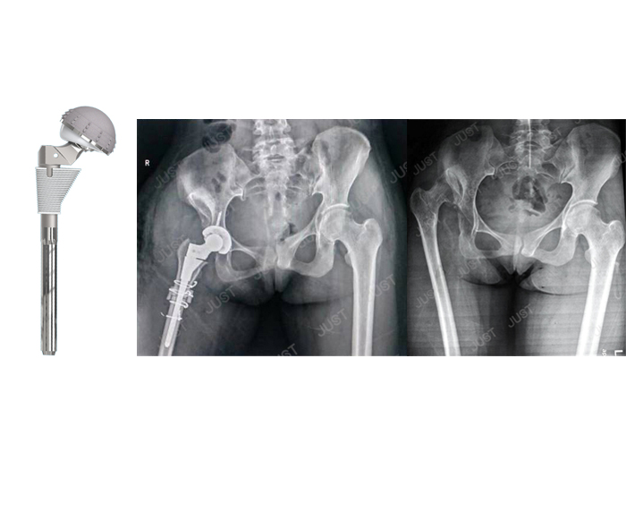 JUST X-Ray picture set- Hip joint