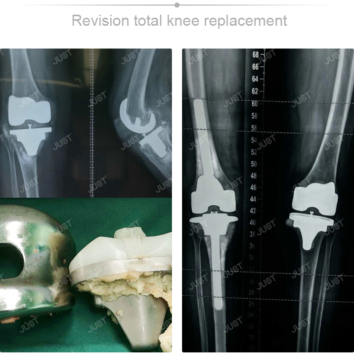 JUST X-Ray picture set- Knee joint