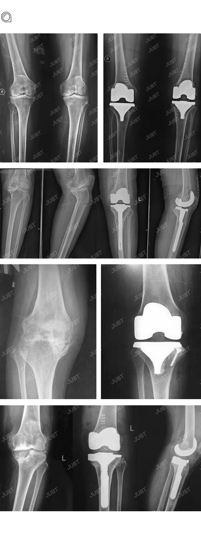 Advantages and disadvantages of PS knee joint prosthesis