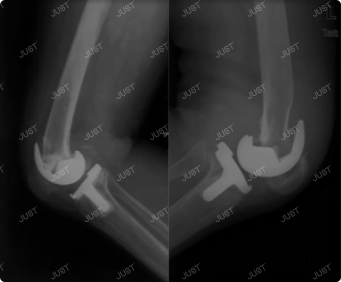 When do we need constrained condylar knee joint prosthesis？
