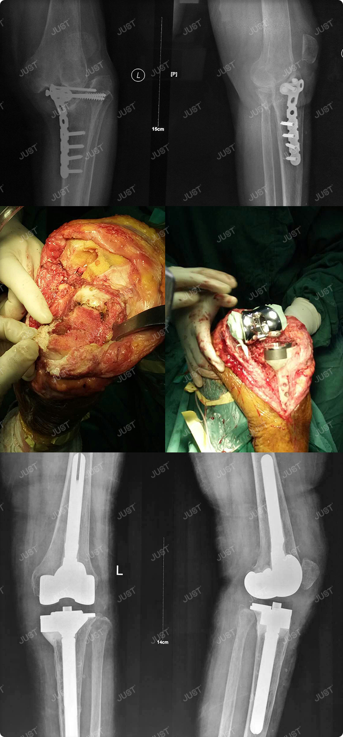 Application of CCK prosthesis in revision of knee joint
