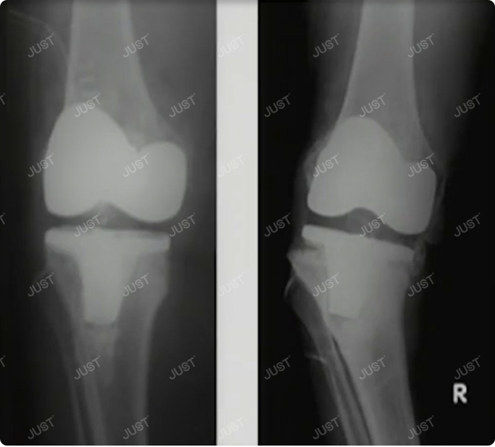 Knowledge of revision knee joint (2)