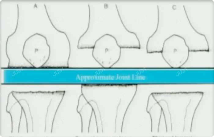 7 steps of knee revision surgery (3)