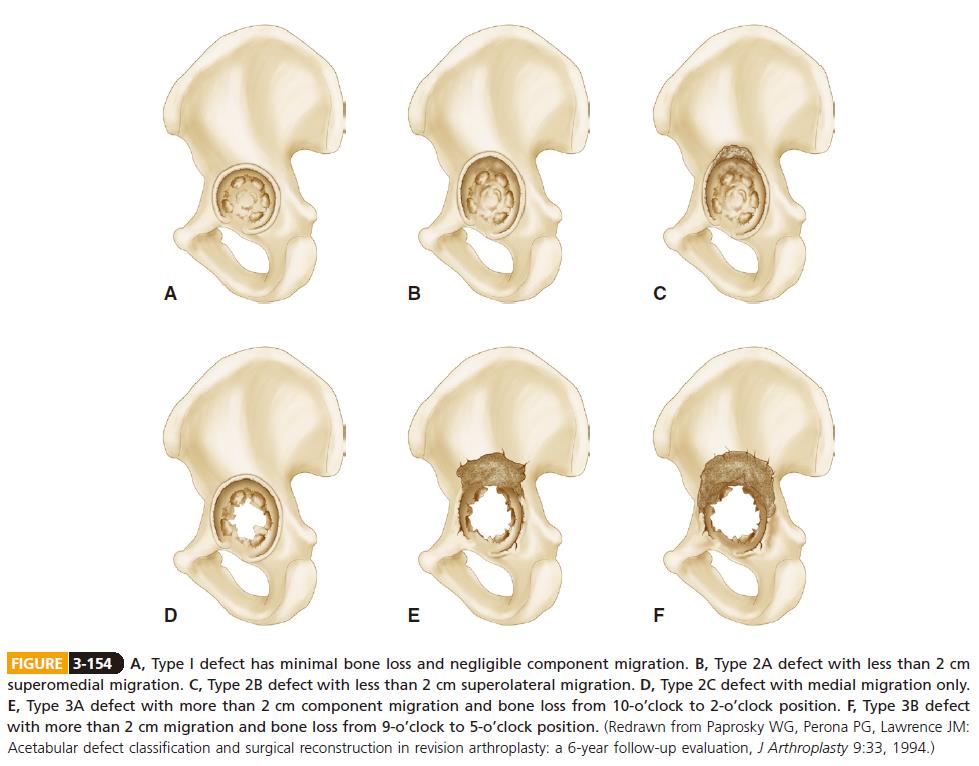 Reconstruction of acetabular deficiencies- Paprosky classification