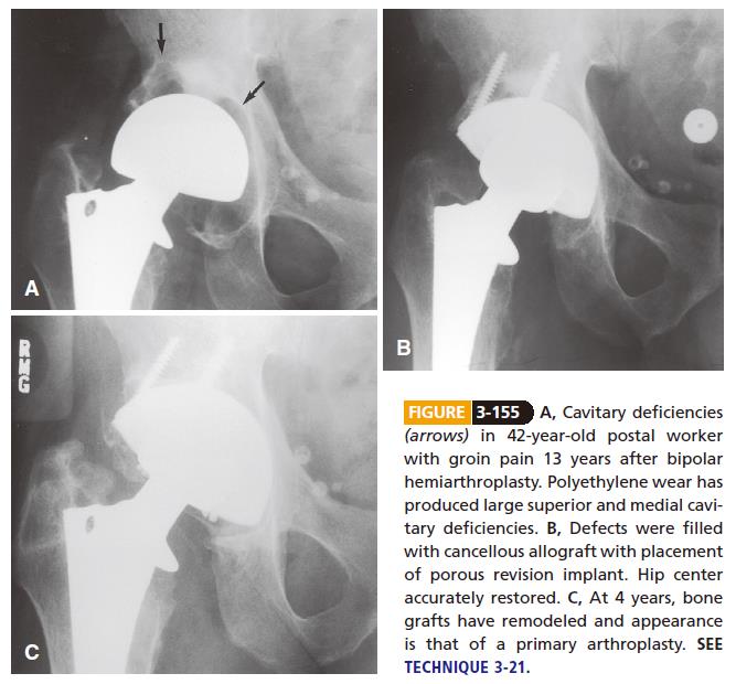 Management of acetabular cavitary deficits