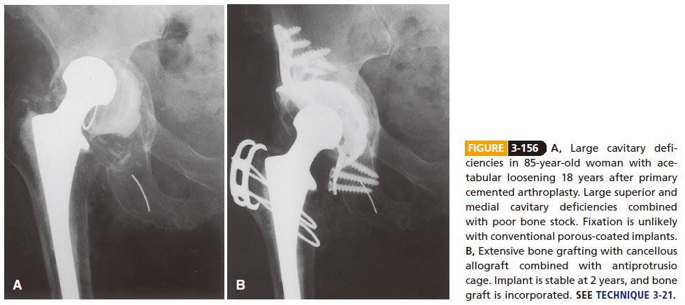Management of acetabular cavitary deficits