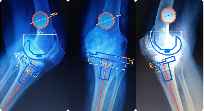 Case of SKI PS High Flexion Total Knee System
