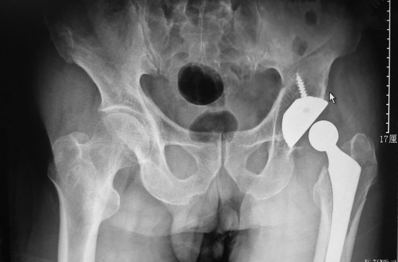 Revision of hip joint in elderly patients
