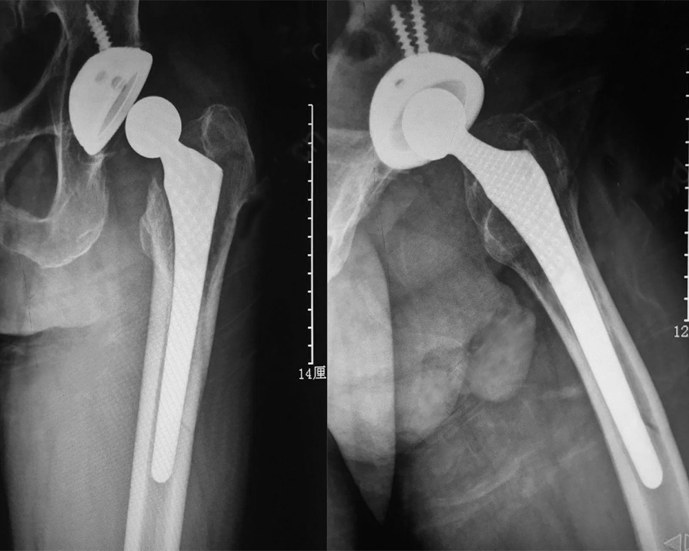 Revision of hip joint in elderly patients