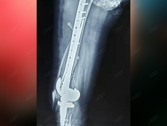 Successful surgery of JUST's knee in Vietnam