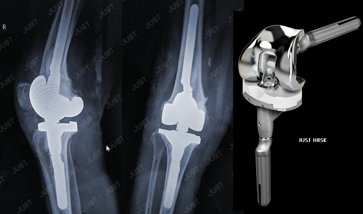 Rotating hinge: a simple and effective solution for complex knee arthroplasty