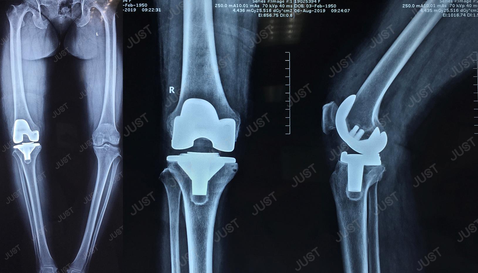 Case of SKII CR High Flexion Total Knee System