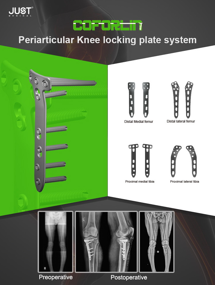 Coforline® Periarticular Locking Plate System
