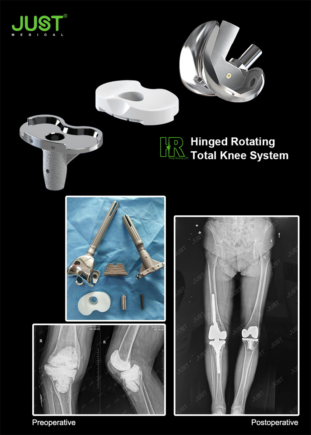 HRSK® Hinged Rotating Knee System