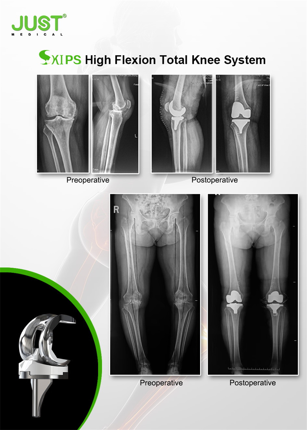 SKI®PS High Flexion Total Knee System
