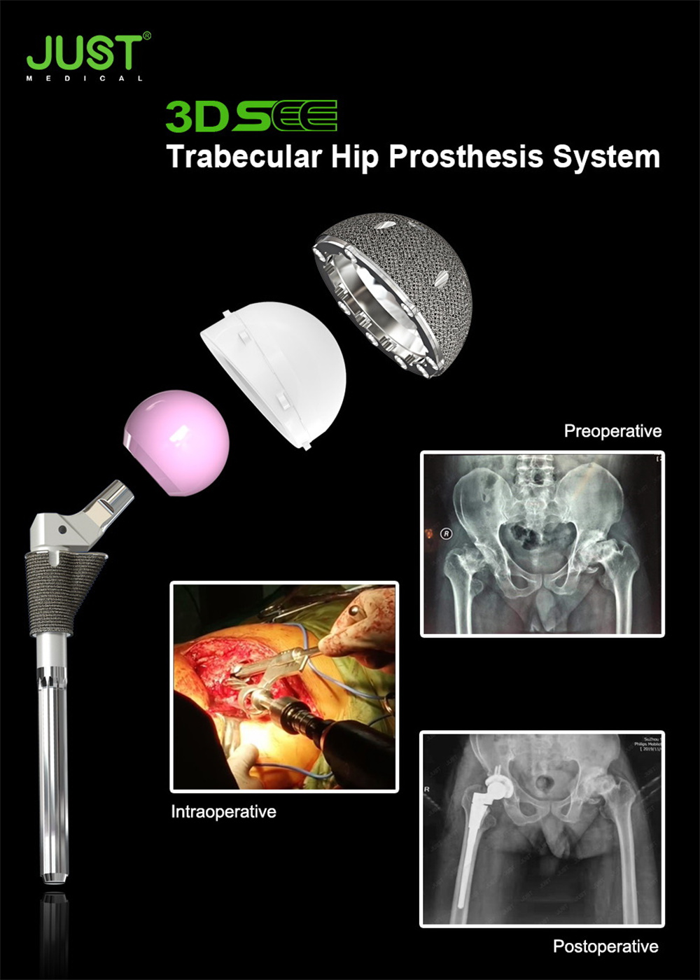 SEE® Trabecular Acetabular Cup System