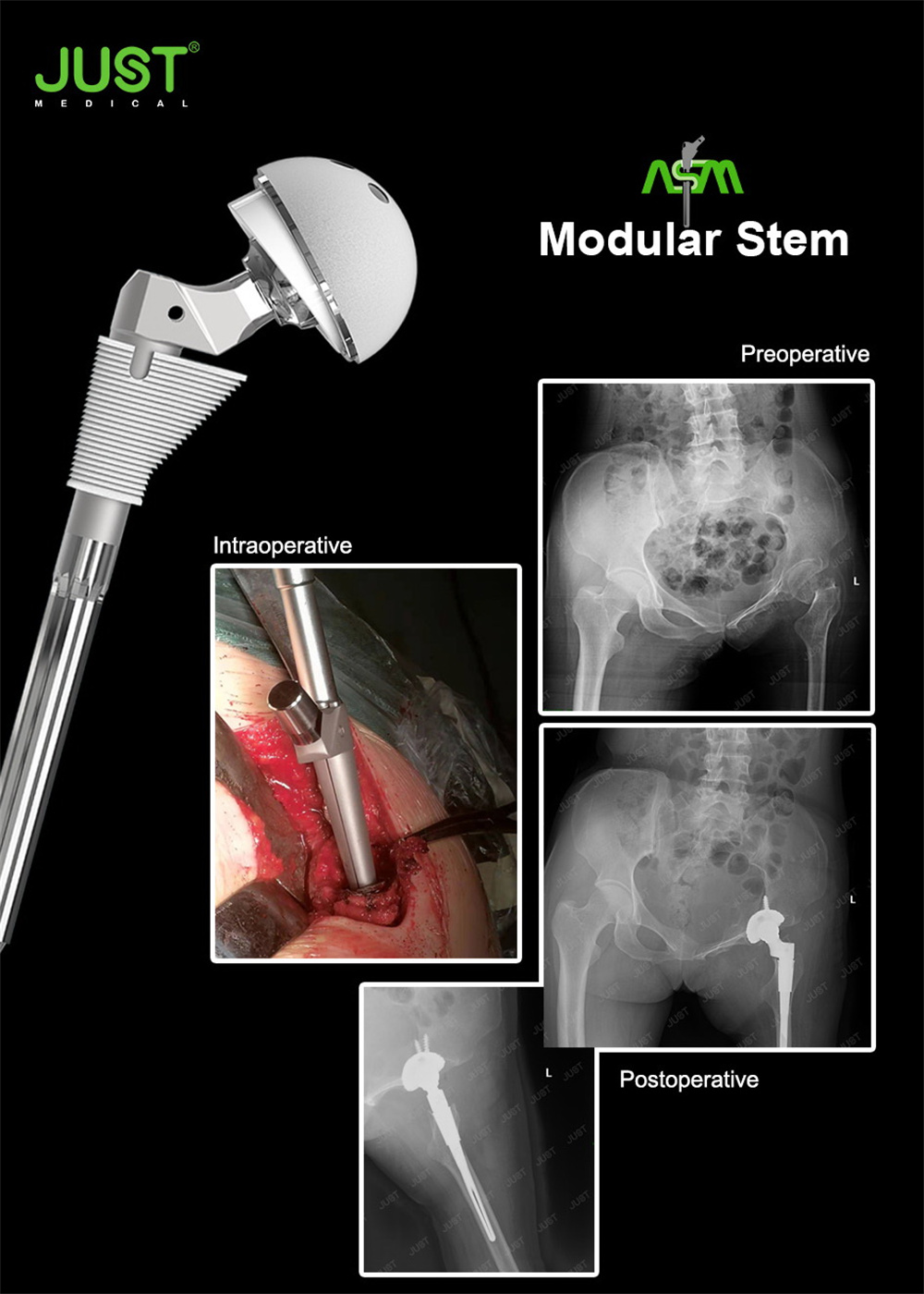 Asm Hip Joint System
