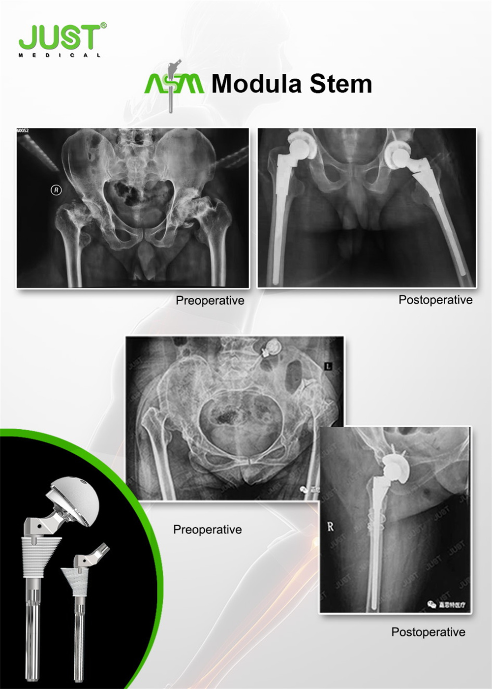 Asm Hip Joint System