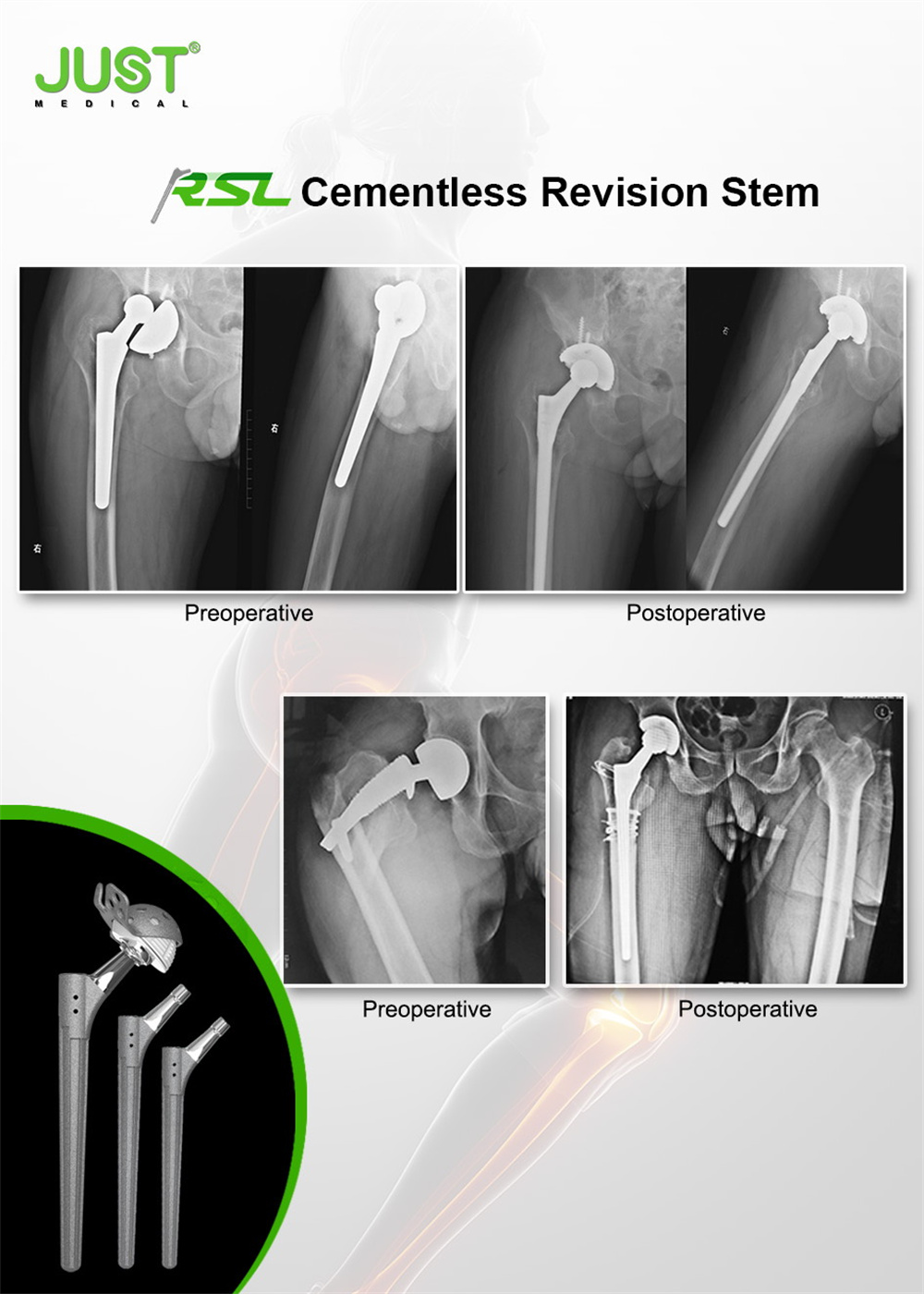 RSL Revision cementless femoral stem
