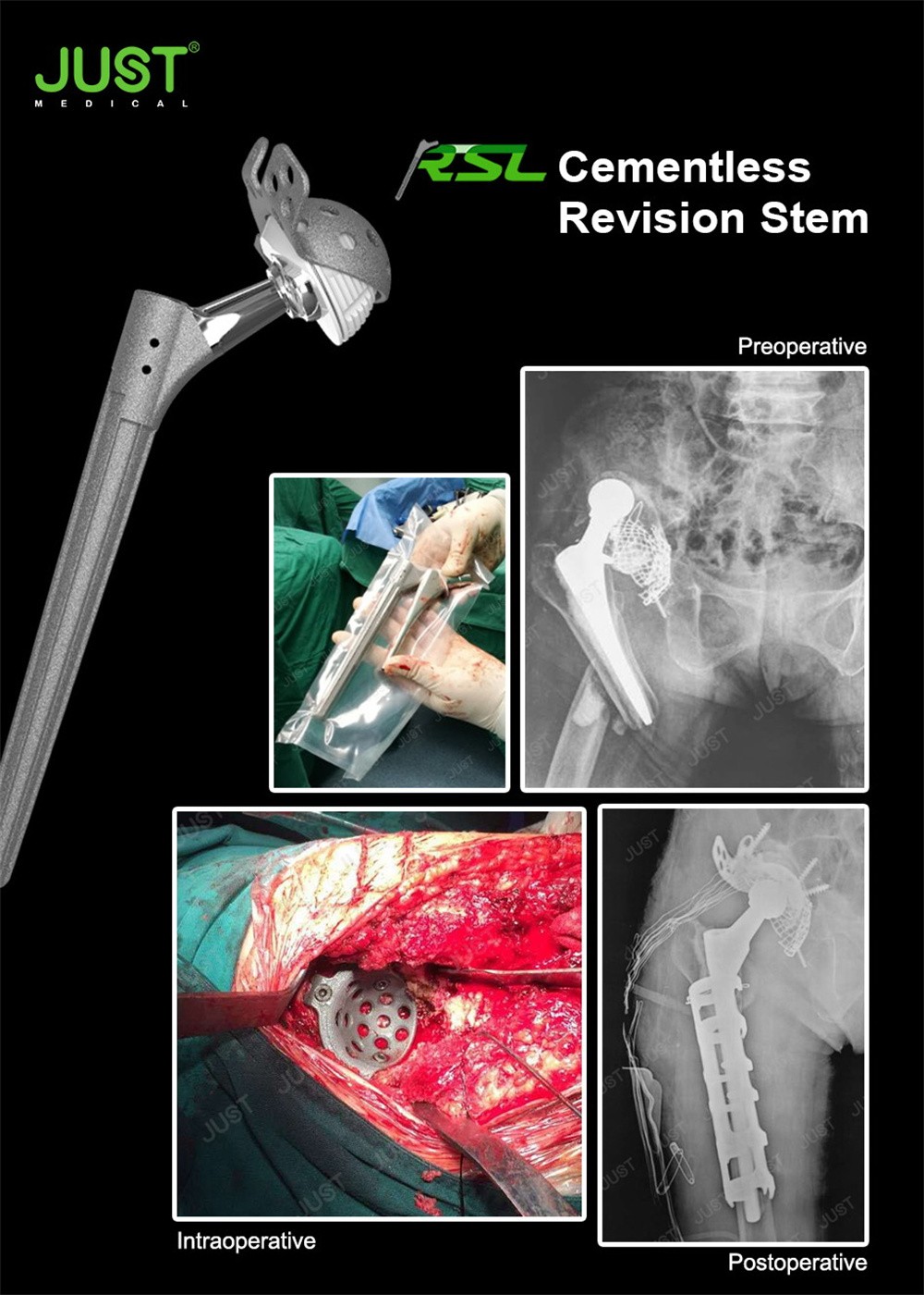 RSL Revision cementless femoral stem