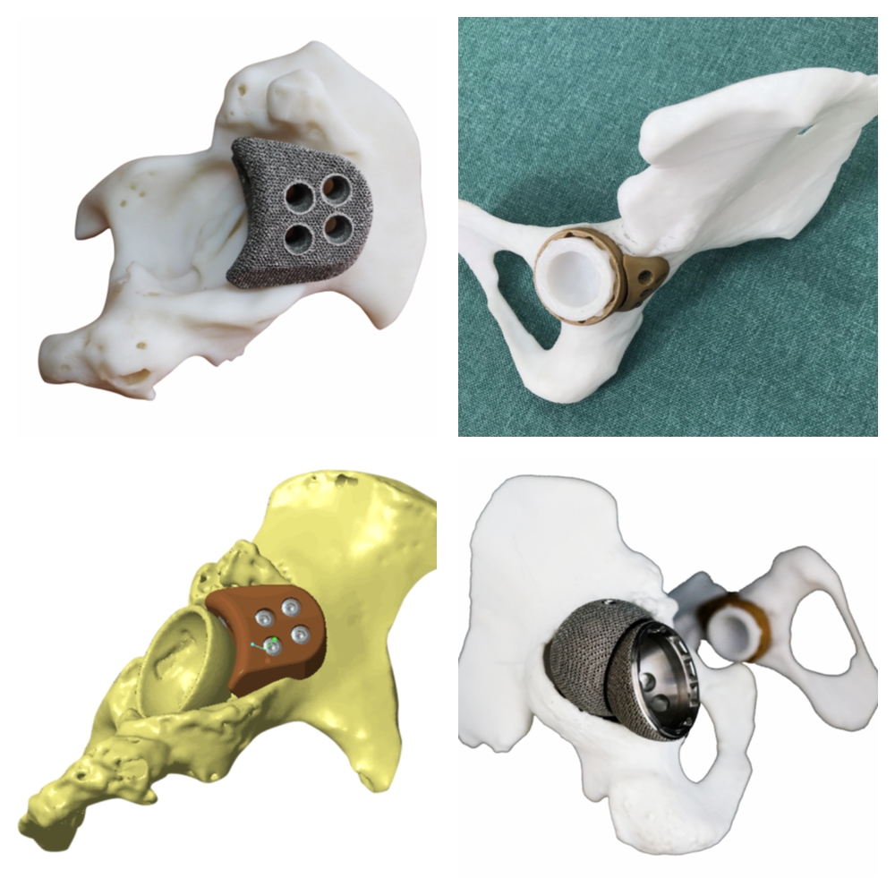 3D Printing Customized Joint Prothesis Products