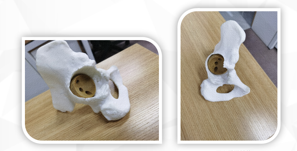 3D Printing Customized Joint Prothesis Products