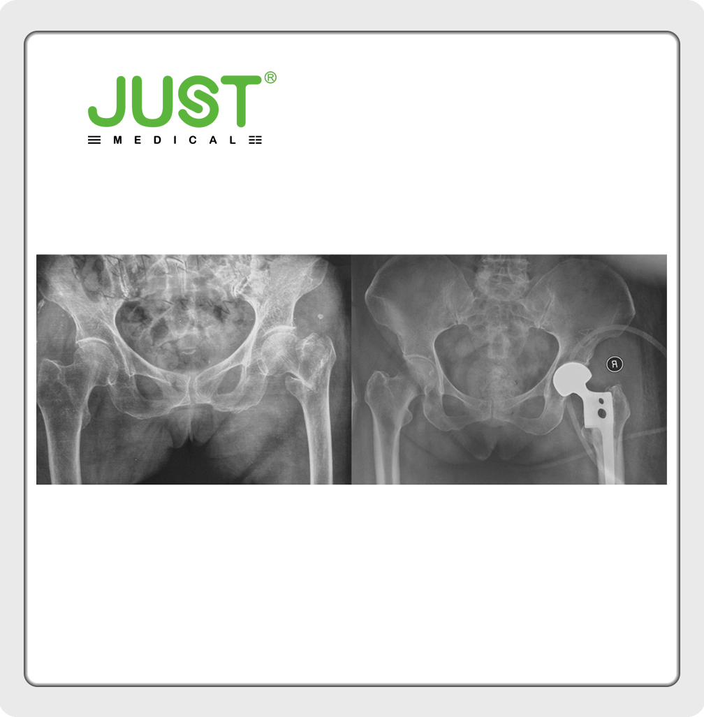 Jt Hip Joint System