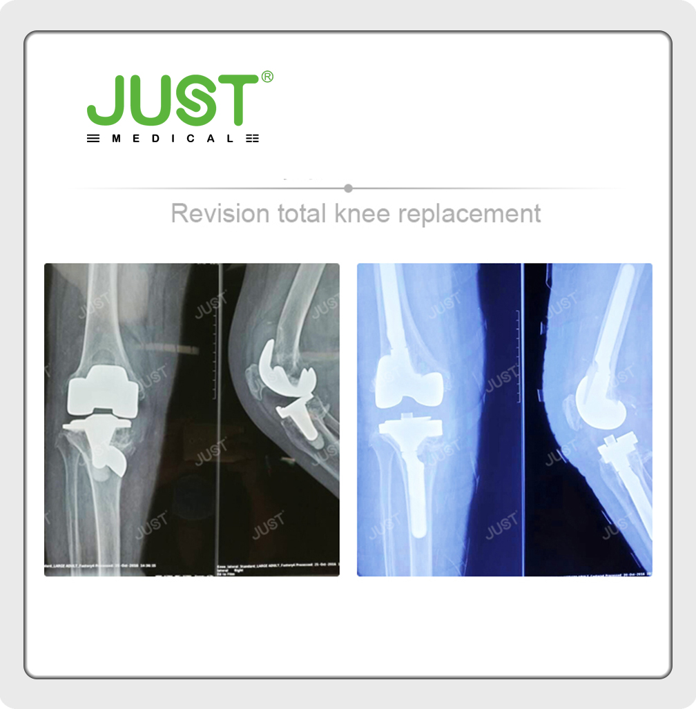 JUST X-Ray picture set- Knee joint